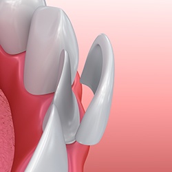 Animation of porcelain veneer placement