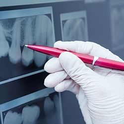 Dental x-rays of root canal treated teeth