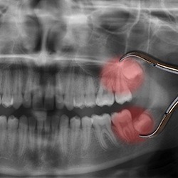 X-rays of highlighted teeth that are in impacted