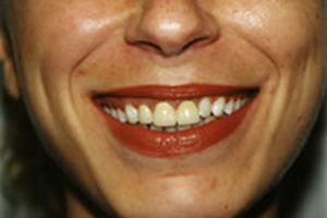Closeup of discolored teeth