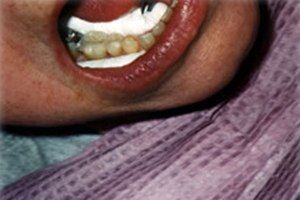Smile flawlessly repaired with tooth-colored fillings