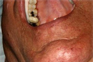 Two top teeth with tooth-colored restorations