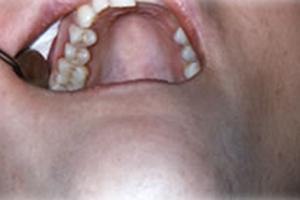 Row of metal fillings replaced with tooth-colored restorations