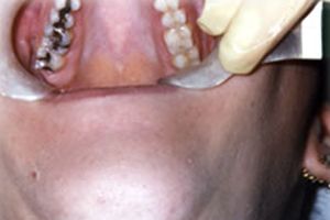 Teeth with row of metal fillings