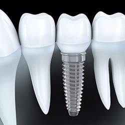 Animation of implant supported replacement tooth