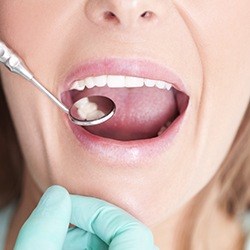 Closeup of smile during dental sealant placement