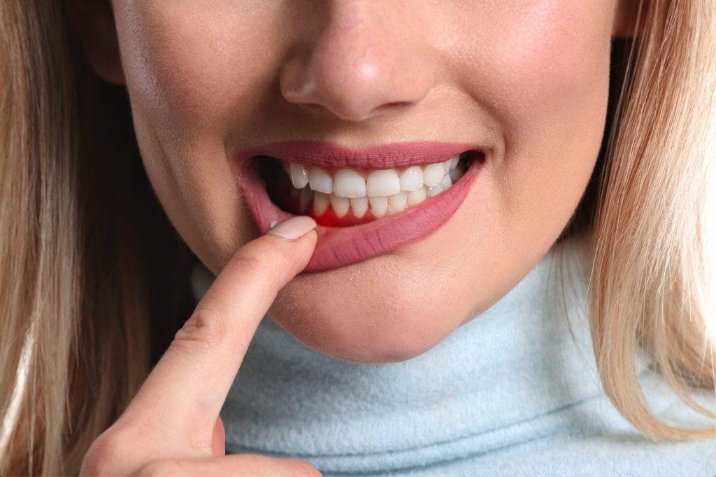 Woman with gum disease