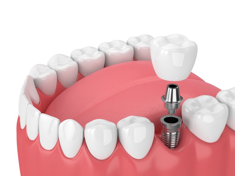 Dental implant illustration