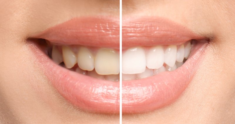 Professional teeth whitening from cosmetic dentist