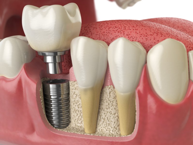 Dental implant